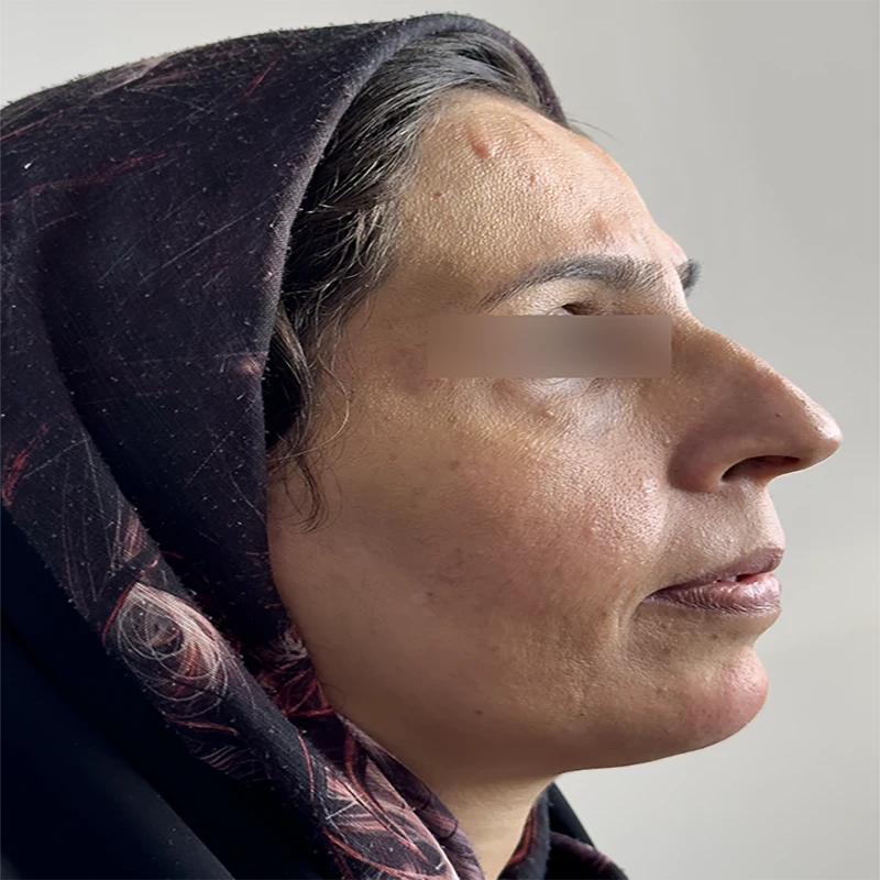 قبل از ژل چانه و شقیقه