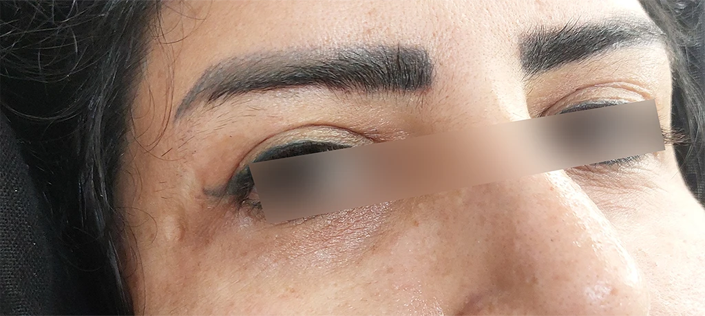 بعد از لیفت پلک 1