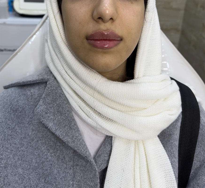 بعد از تزریق ژل لب