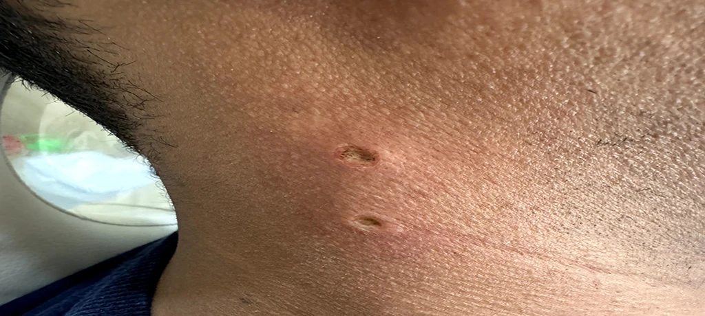 بعد از خال برداری 1