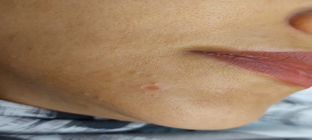 بعد از خال برداری 2