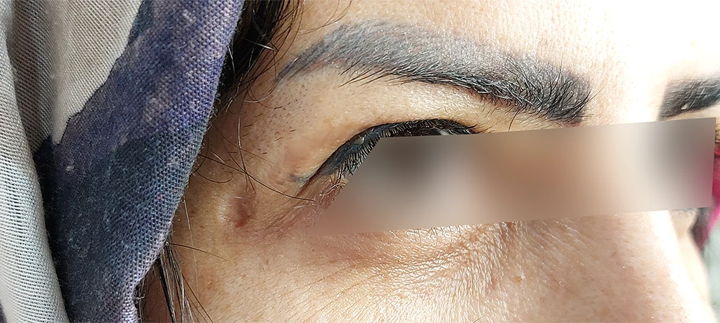 قبل از لیفت پلک 1