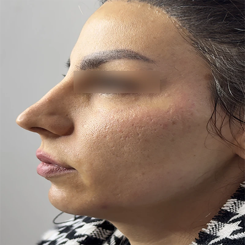 قبل از ژل زاویه دار کردن فک و گونه