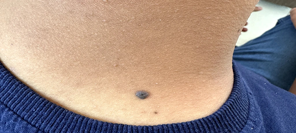 قبل از خال برداری 2