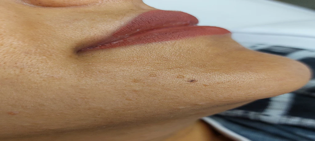 قبل از خال برداری 2