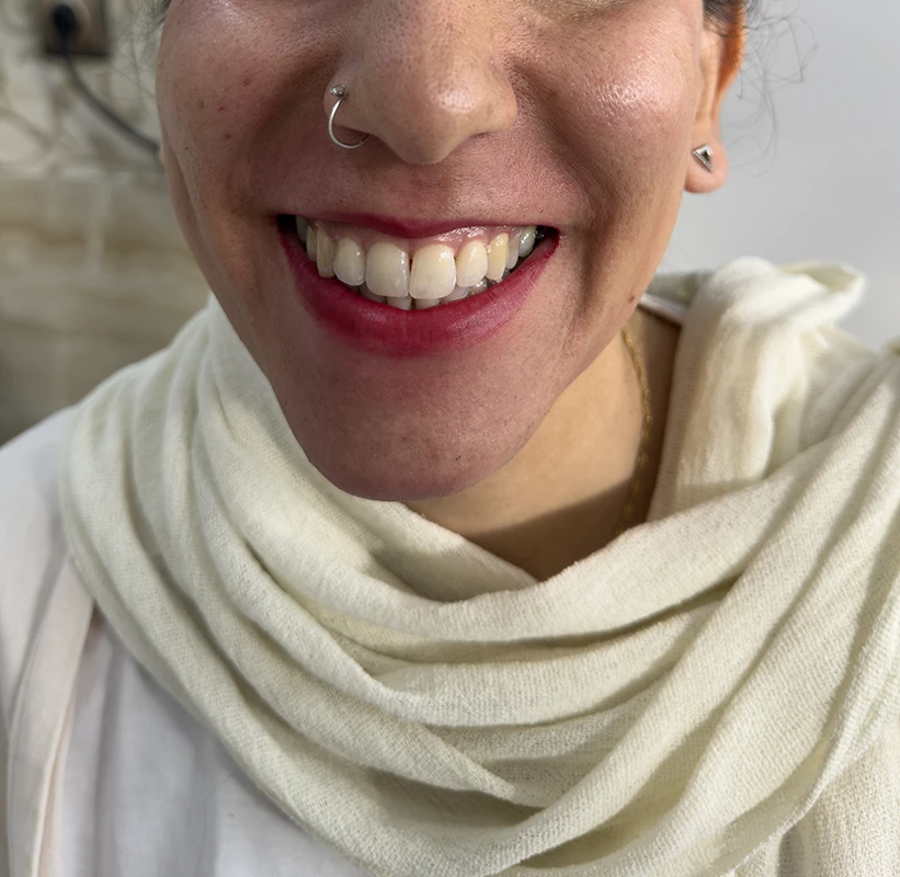 ژل قبل از لبخند و غم