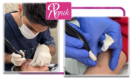 بلفاروپلاستی پلک و خال برداری