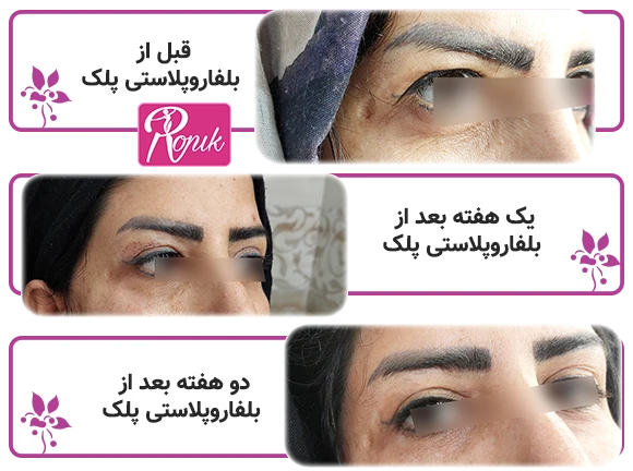 بلفاروپلاستی پلک