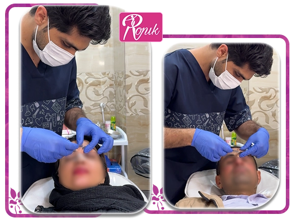 تزریق بوتاکس در کلینیک رونیک