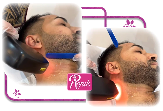 لیزر موهای زائد آیس پلاس اندیاگ