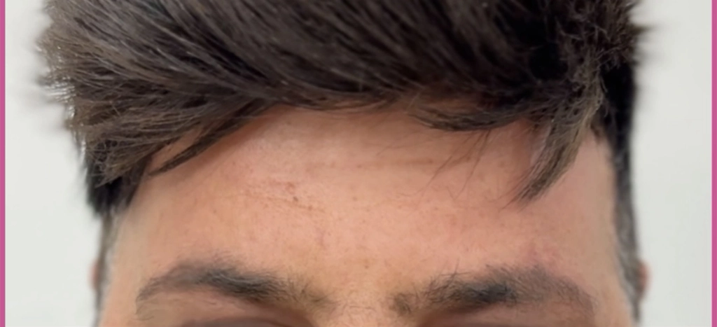 بعد از بوتاکس مرد 2