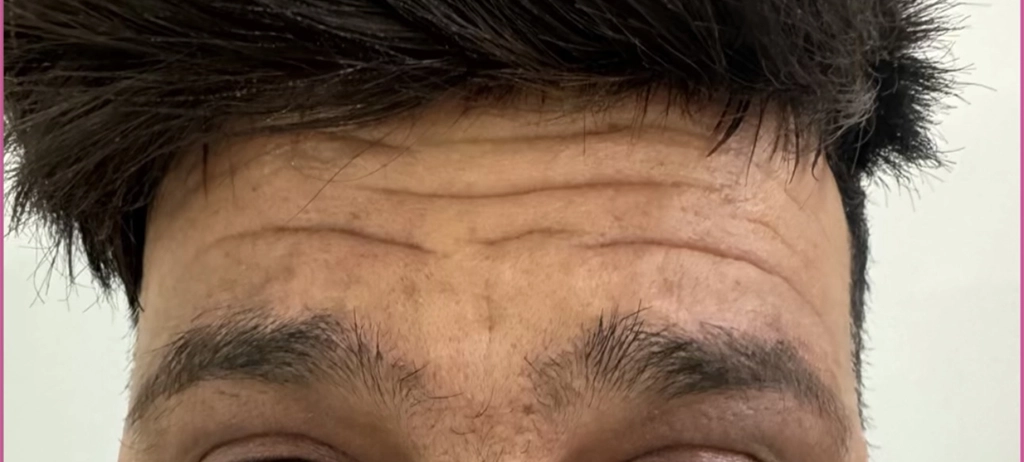 قبل از بوتاکس مرد 2