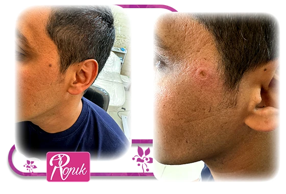 خالبرداری با پلاسماجت