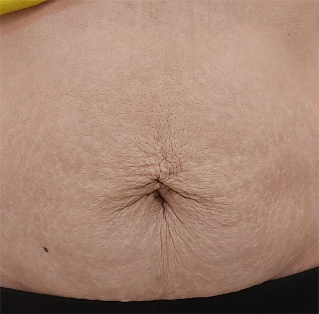 لاغری موضعی بعد1