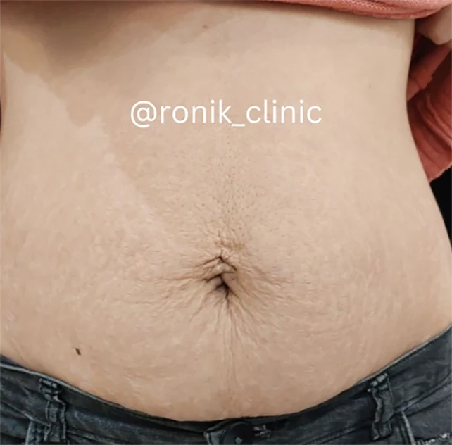 لاغری موضعی قبل 2