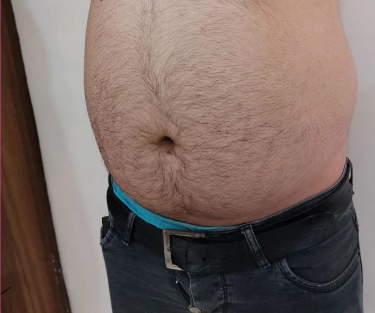 لاغری موضعی شکم قبل 3