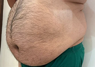 لاغری موضعی شکم قبل 4