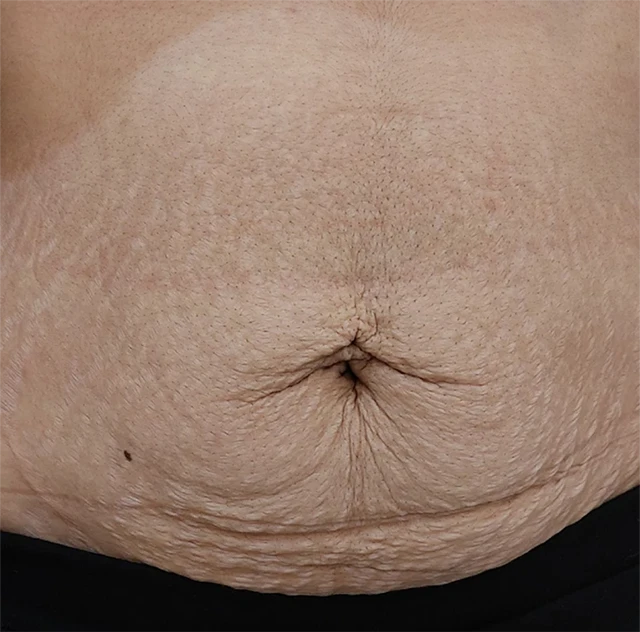 لاغری موضعی قبل 1