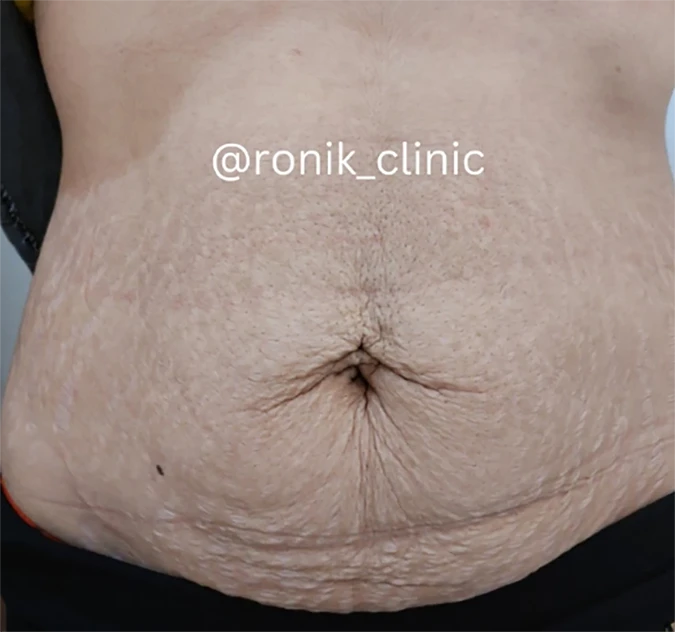 لاغری موضعی قبل 2