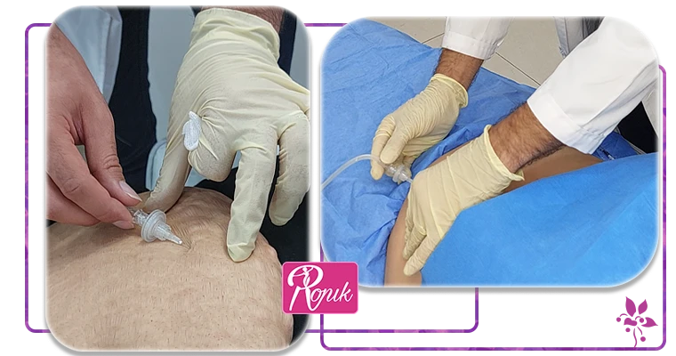 ماندگاری کربوکسی تراپی