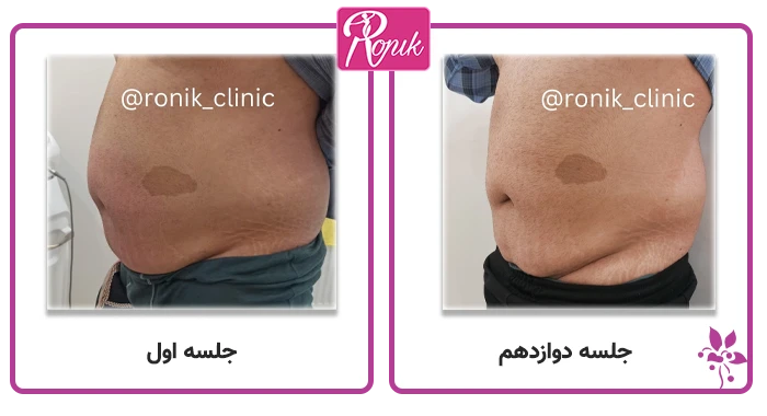 مزایای آر اف فرم‌دهی بدون