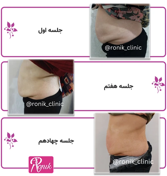 روش‌های متنوع لاغری رونیک