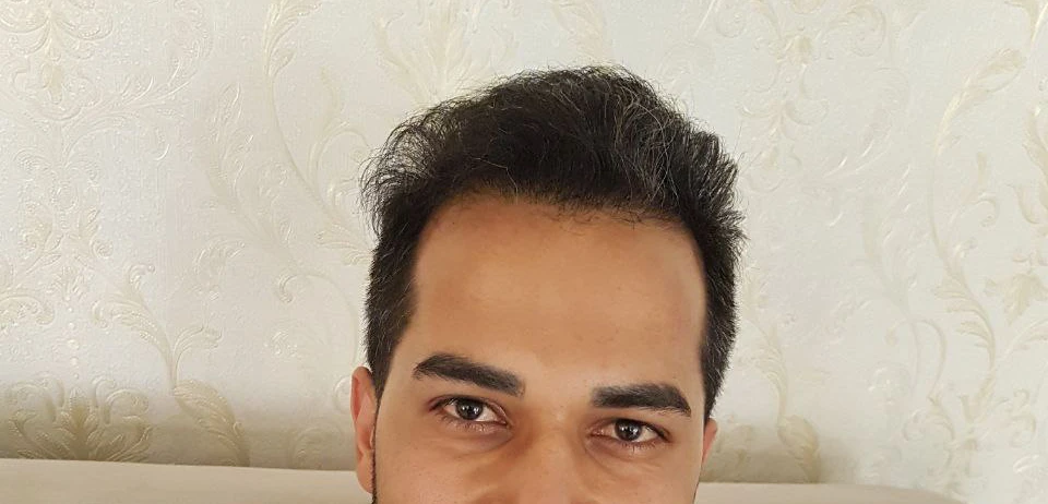 بعد از بوتاکس مرد 3