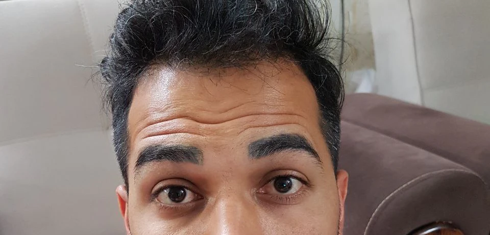 قبل از بوتاکس مرد 3