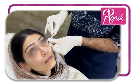 مزوتراپی، زیبایی طبیعی پوست