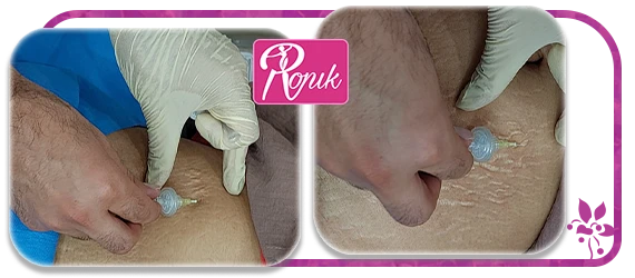 انواع کربوکسی تراپی