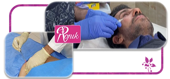 انواع مزوتراپی در کلینیک رونیک