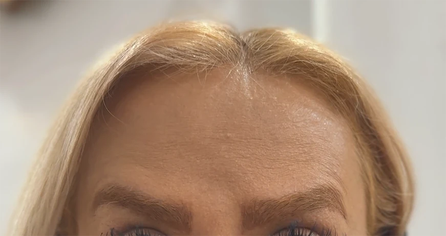 بعد از بوتاکس زن 1