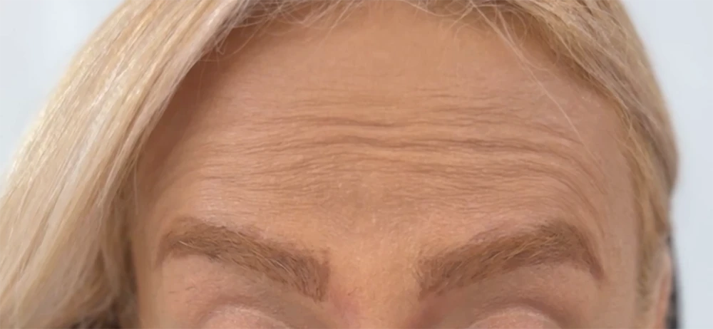 قبل از بوتاکس زن 1